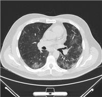Многосрезовая спиральная компьютерная томография (МСКТ) грудной полости (легкие и средостение) с внутривенным болюсным контрастированием